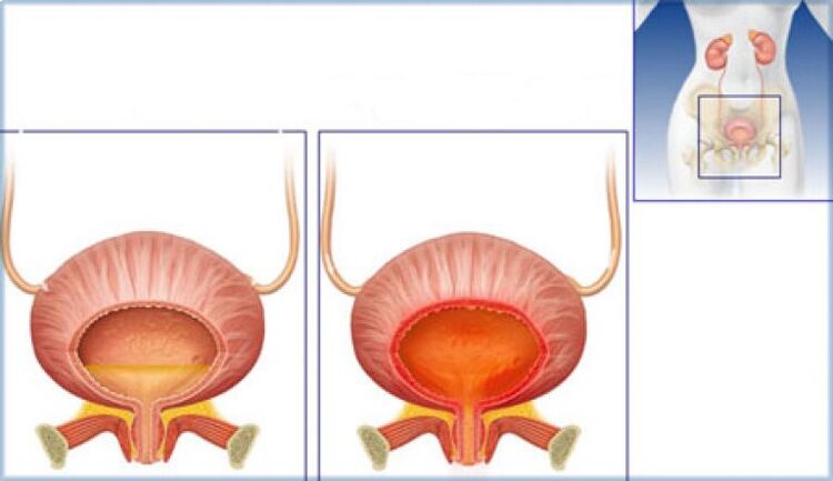 Normal bladder with signs of inflammation caused by cystitis