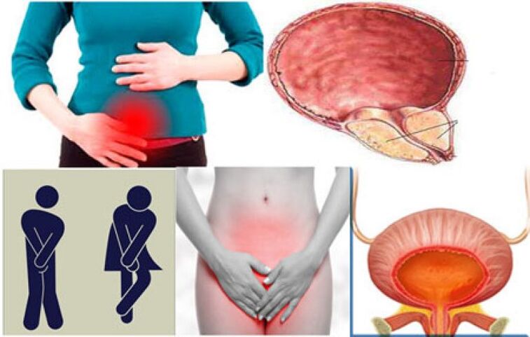 Symptoms of cystitis in women – burning and pain during urination